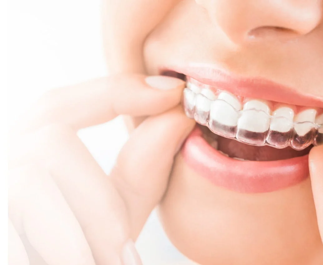 Invisalign Clear Aligners Bradford Shipley Idle Appointments Announced for New Private Patients at Taylored Dental Care